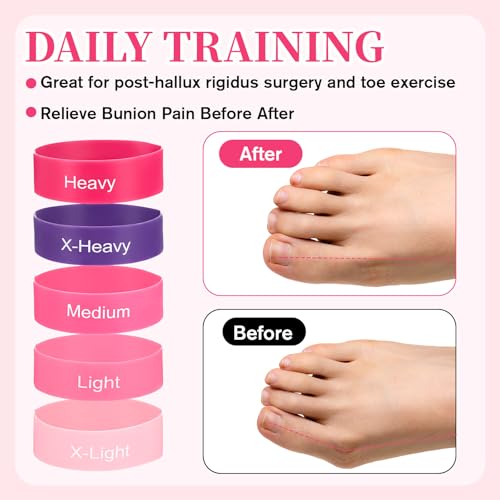 TIESOME 5 PCS Toe Bands Big Toe Spacers for Bunion Correction, Toe Stretcher Bands Toe Spacers Resistance Straightener Loop Band with Storage Bag for Women Men(Pink)