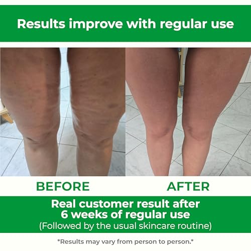TESMED Cellulite Manual Massager Roller for Thighs and Buttocks